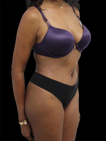 Tummy Tuck Before & After Patient #2744