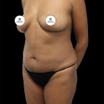 Tummy Tuck Before & After Patient #2745