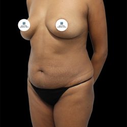Tummy Tuck Before & After Patient #2745