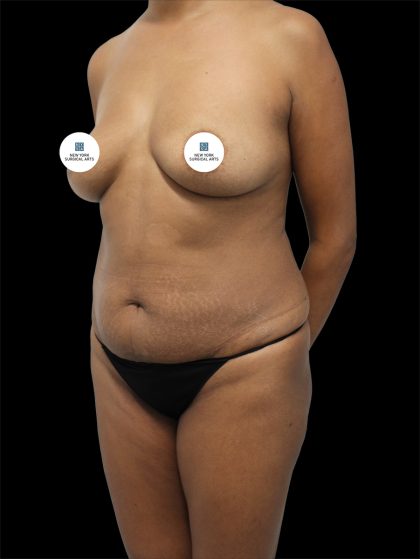 Tummy Tuck Before & After Patient #2745