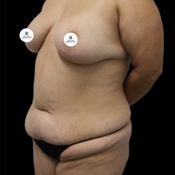 Tummy Tuck Before & After Patient #2746