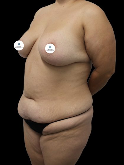 Tummy Tuck Before & After Patient #2746