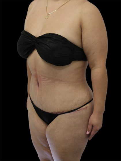 Tummy Tuck Before & After Patient #2746