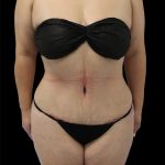 Tummy Tuck Before & After Patient #2746