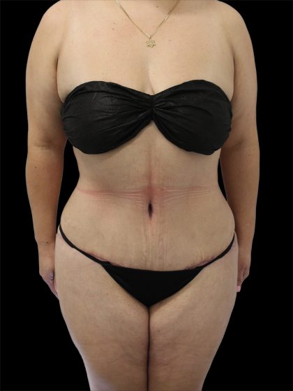 Tummy Tuck Before & After Patient #2746