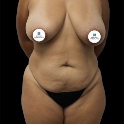 Tummy Tuck Before & After Patient #2747
