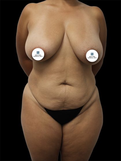 Tummy Tuck Before & After Patient #2747