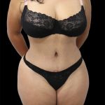 Tummy Tuck Before & After Patient #2747