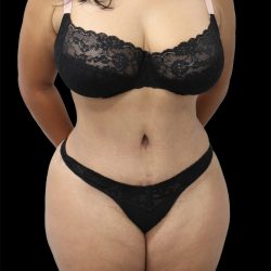 Tummy Tuck Before & After Patient #2747