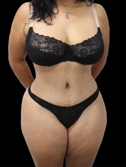 Tummy Tuck Before & After Patient #2747