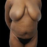 Tummy Tuck Before & After Patient #2688