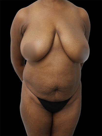 Tummy Tuck Before & After Patient #2688