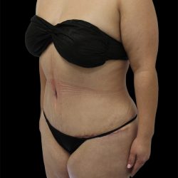 Tummy Tuck Before & After Patient #2748