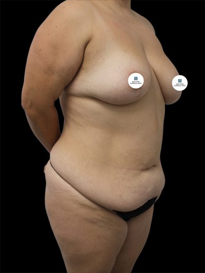 Tummy Tuck Before & After Patient #2748