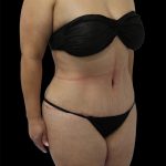 Tummy Tuck Before & After Patient #2748