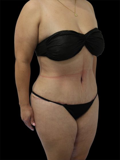 Tummy Tuck Before & After Patient #2748