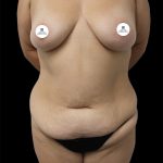 Tummy Tuck Before & After Patient #2748