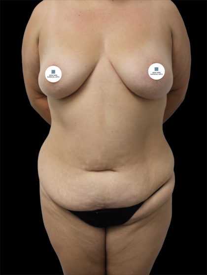 Tummy Tuck Before & After Patient #2748