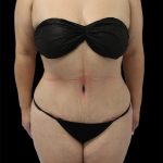 Tummy Tuck Before & After Patient #2748