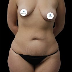 Tummy Tuck Before & After Patient #2783