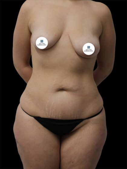 Tummy Tuck Before & After Patient #2783