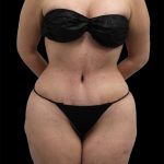 Tummy Tuck Before & After Patient #2783