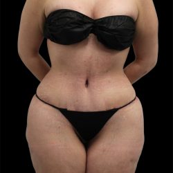 Tummy Tuck Before & After Patient #2783