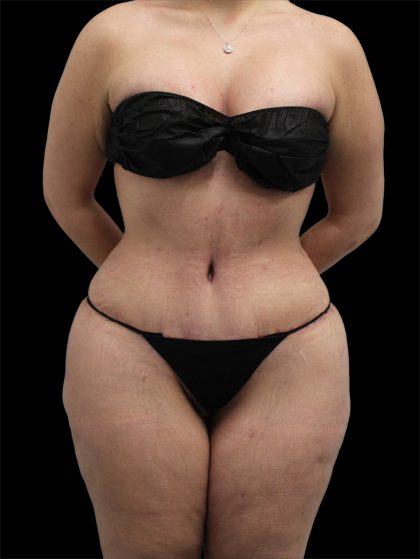Tummy Tuck Before & After Patient #2783