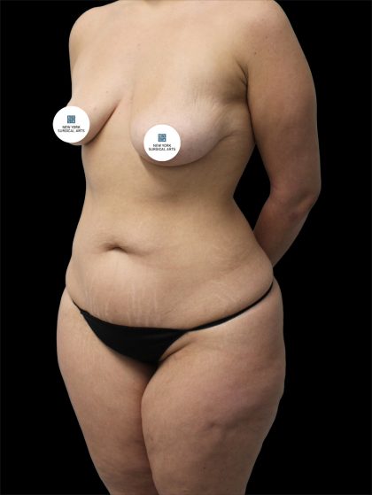 Tummy Tuck Before & After Patient #2783