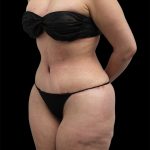 Tummy Tuck Before & After Patient #2783