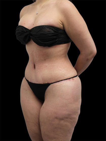 Tummy Tuck Before & After Patient #2783