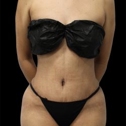 Tummy Tuck Before & After Patient #2784