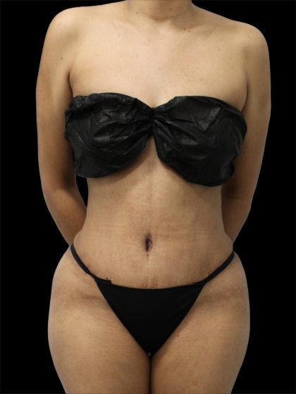 Tummy Tuck Before & After Patient #2784