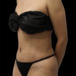 Tummy Tuck Before & After Patient #2784