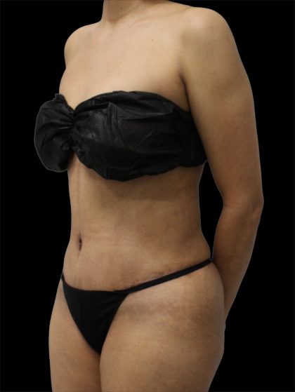 Tummy Tuck Before & After Patient #2784