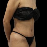 Tummy Tuck Before & After Patient #2784