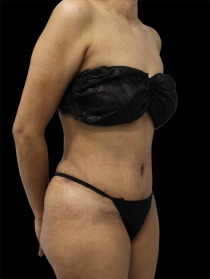 Tummy Tuck Before & After Patient #2784