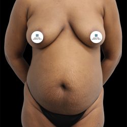 Tummy Tuck Before & After Patient #2785