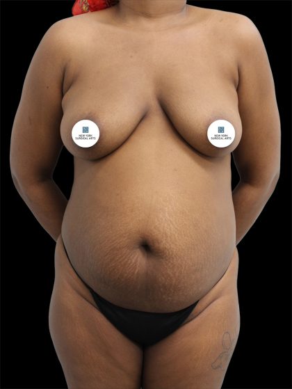 Tummy Tuck Before & After Patient #2785