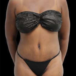 Tummy Tuck Before & After Patient #2785