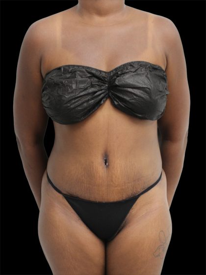 Tummy Tuck Before & After Patient #2785
