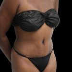 Tummy Tuck Before & After Patient #2785