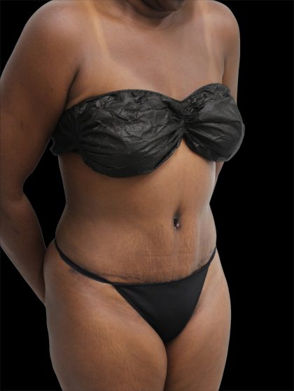 Tummy Tuck Before & After Patient #2785