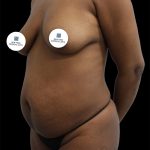 Tummy Tuck Before & After Patient #2785