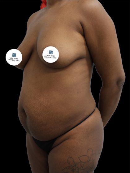 Tummy Tuck Before & After Patient #2785