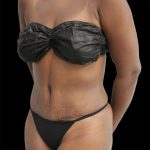 Tummy Tuck Before & After Patient #2785