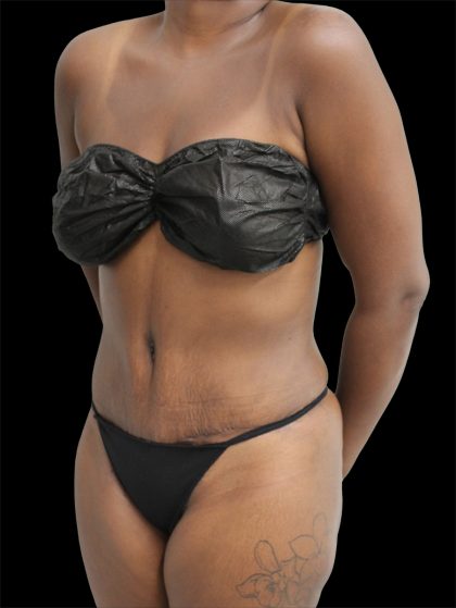 Tummy Tuck Before & After Patient #2785