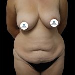 Tummy Tuck Before & After Patient #2786