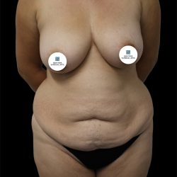Tummy Tuck Before & After Patient #2786