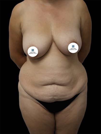 Tummy Tuck Before & After Patient #2786
